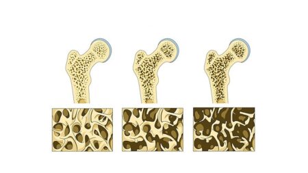 obrazek pokazuje różnice w budowie kości osoby zdrowej i osoby chorej na osteoporozę